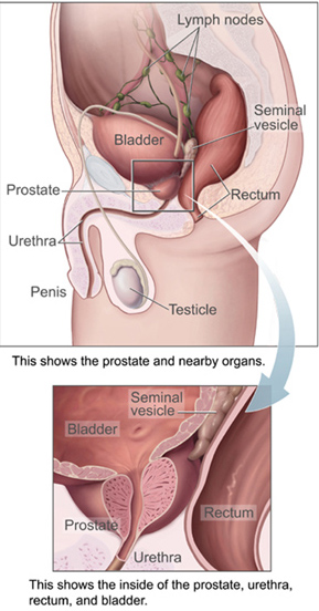 Prostatelead